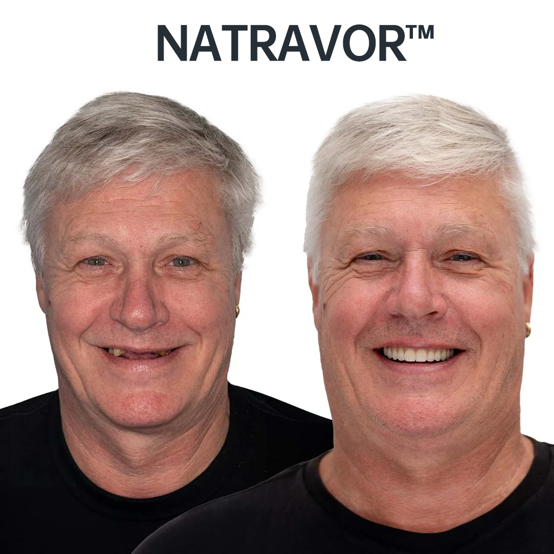 Natravor™ AdaptableFit Funktionella Proteser – Tillverkade i Sverige & MPA-certifierade ✅